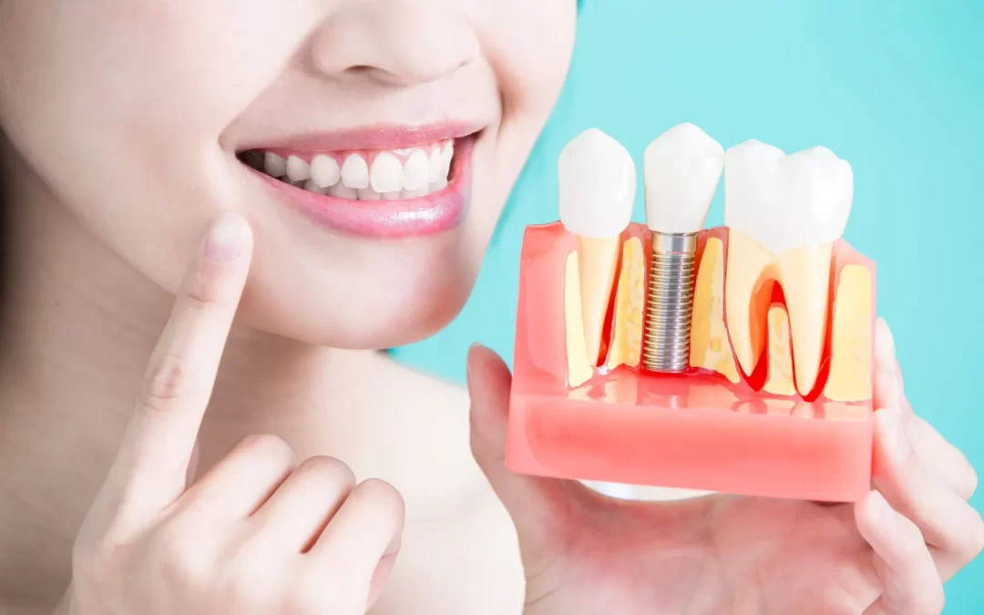 Reasons You May Need a Dental Implant